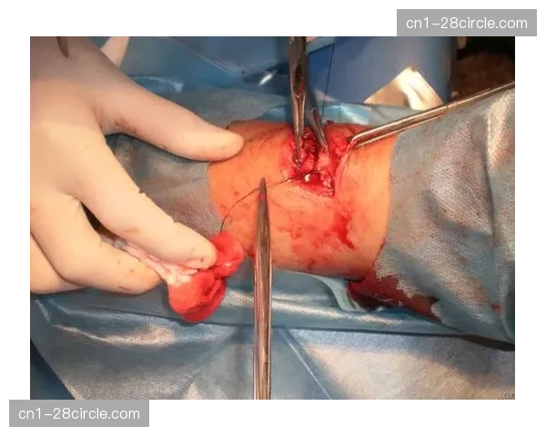 刘易斯·米勒在英冠联赛中受伤，跟腱断裂手术已顺利完成